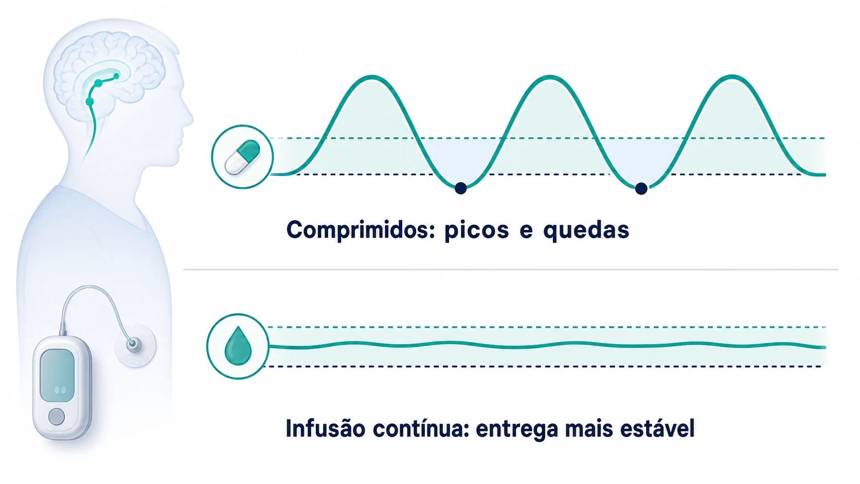 Infográfico com texto comparando “Comprimidos: picos e quedas” versus “Infusão contínua: entrega mais estável”, em uma linha do tempo simples